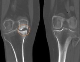 Osteoarthritis of the right knee