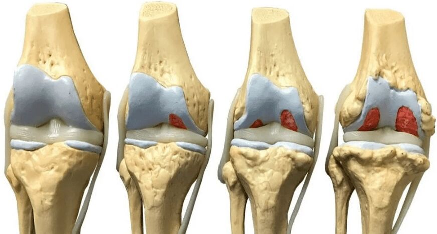 OstyHealth prevents cartilage destruction