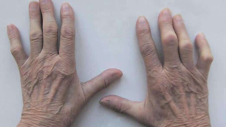 Methods to treat pain in finger joints