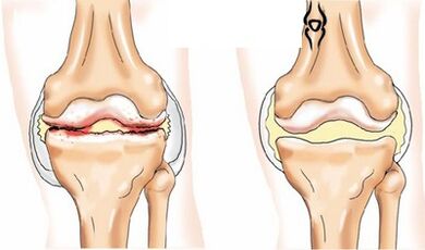Bilateral gonarthrosis