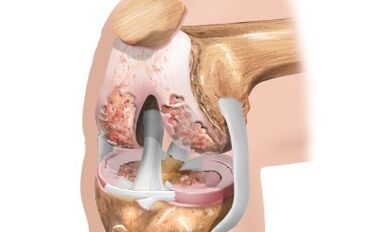Osteoarthritis of the knee joint