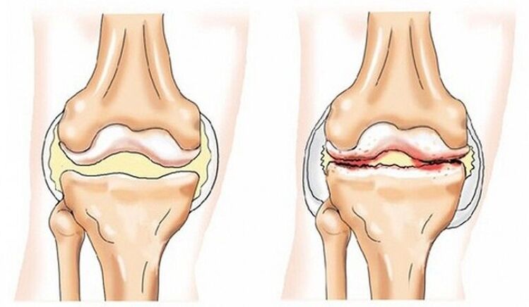 Healthy joint and joint affected by osteoarthritis