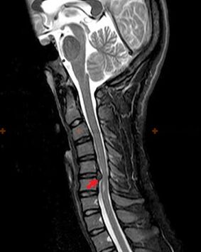 Spinal X-ray