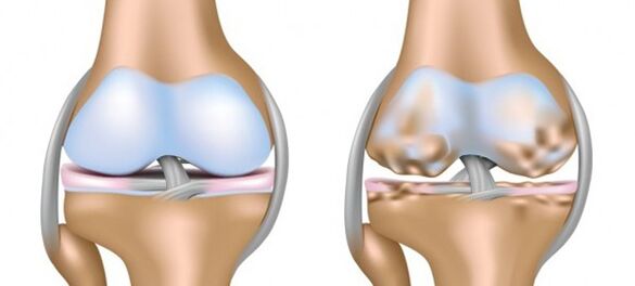 healthy cartilage and cartilage affected by osteoarthritis