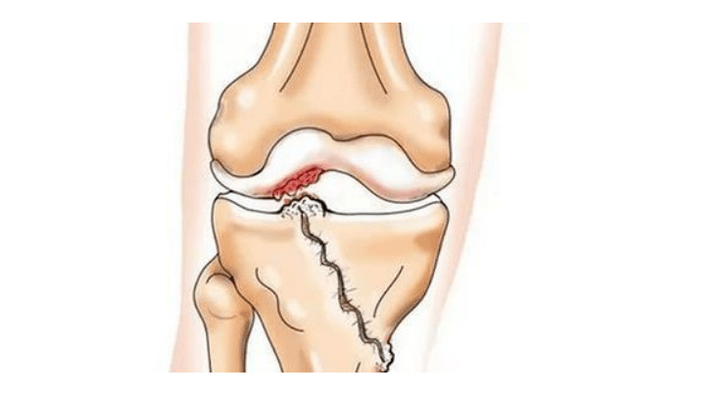 crack in the knee joint