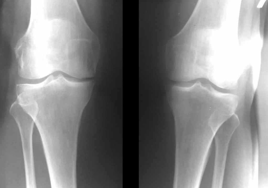 diagnosis of osteoarthritis of the knee joint