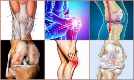 development of osteoarthritis of the knee