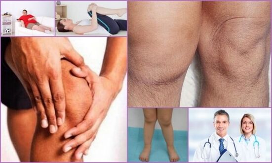 symptoms of osteoarthritis of the knee