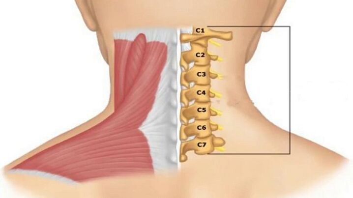 Radicular syndrome manifests itself depending on the vertebra that compresses the nerve endings